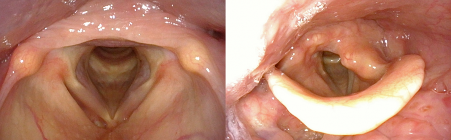 photos juxtaposed of normal larynx and a larynx with vocal fold paralysis