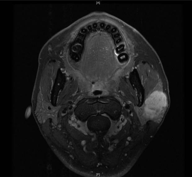 CT scan of Left pleomorphic adenoma of parotid gland