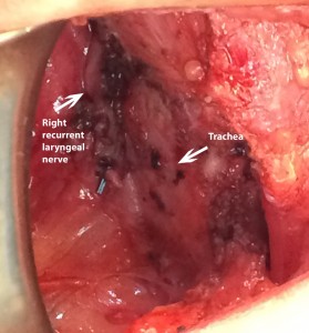 Right recurrent laryngeal nerve after removal of thyroid gland