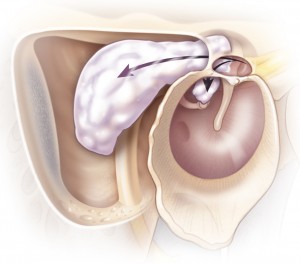 illustration of cholesteatoma